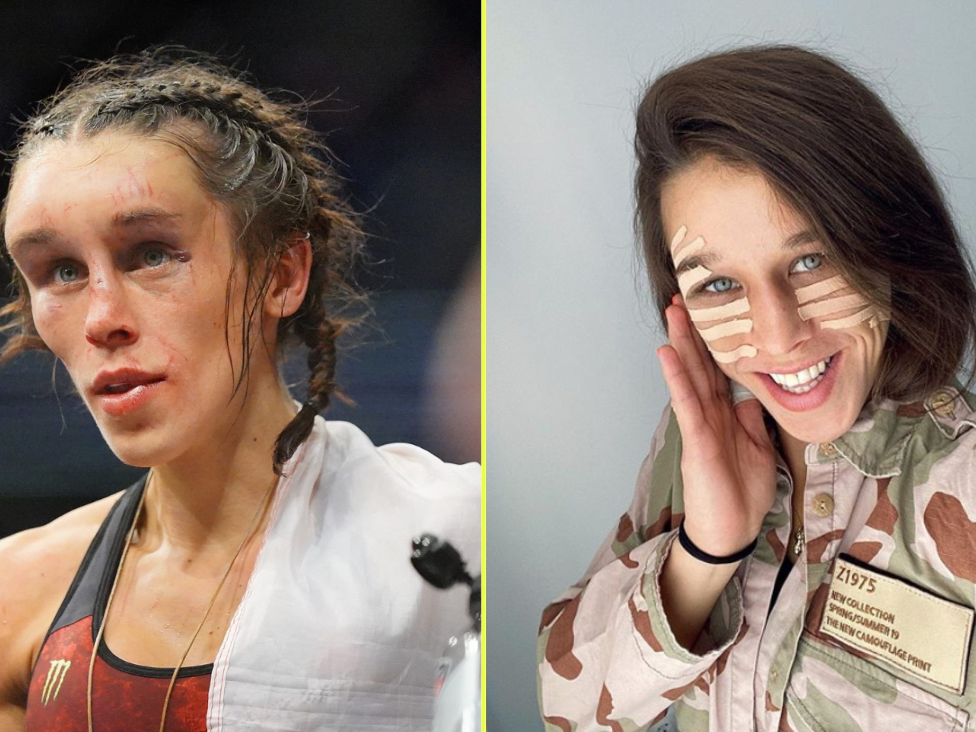 Joanna UFC Hematoma: What Happened and How She Recovered Quickly from the Big Swelling