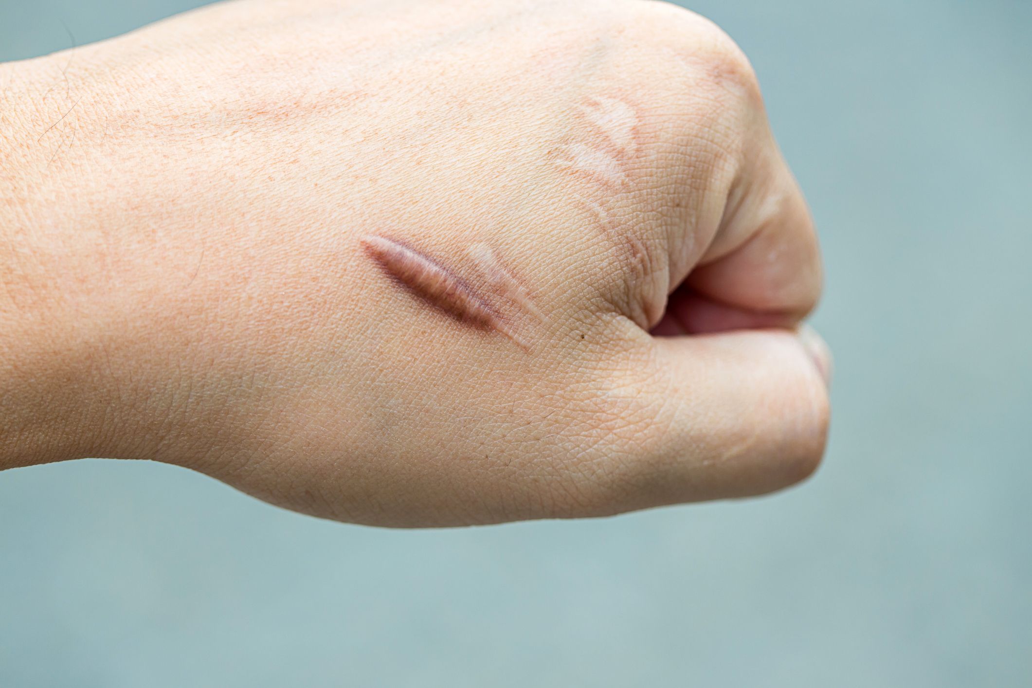 Got Gnarly Scars? Easy Tips to Reduce Their Appearance