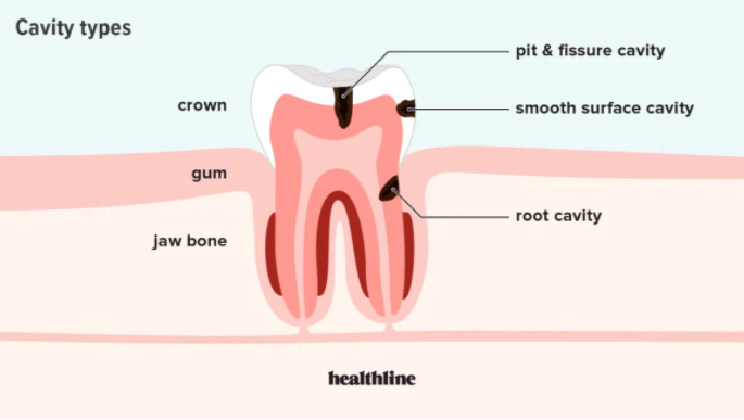 Is It Normal to Have Cavities? Find Out What Dentists Say!