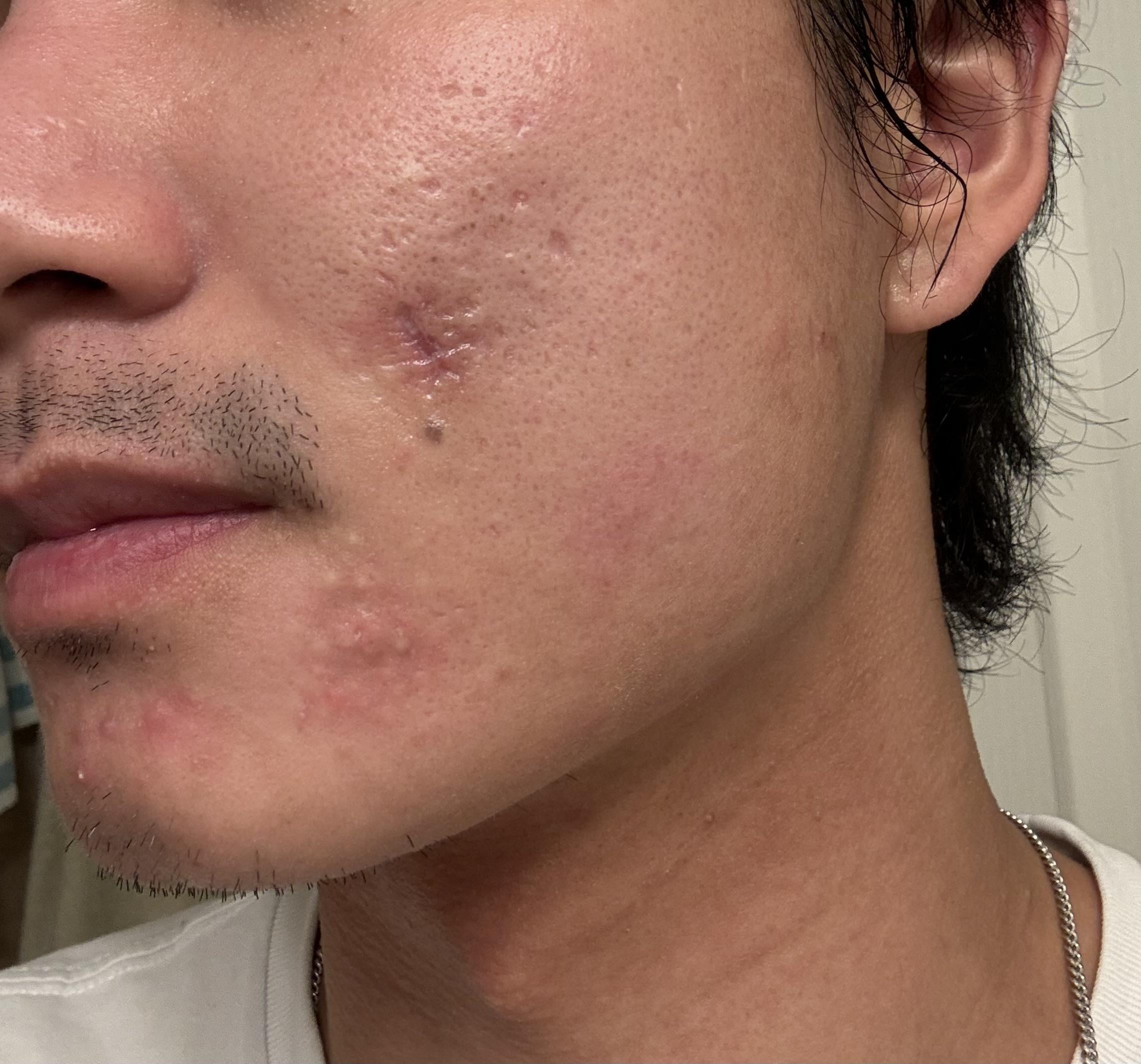 Got Gnarly Scars? Easy Tips to Reduce Their Appearance