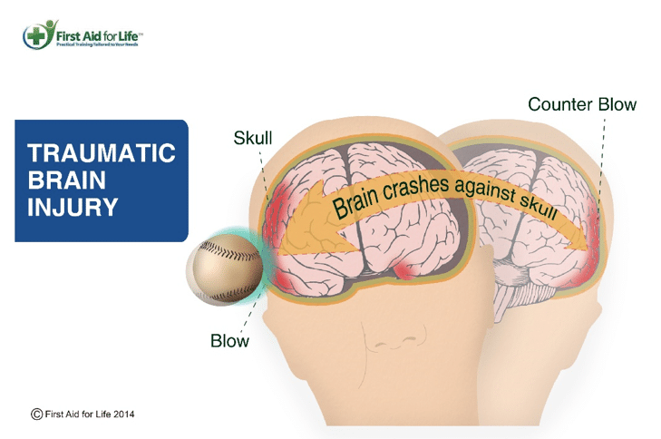 If a basketball player hits head paralyzed, what are the chances? (Doctors thoughts on serious sports head injuries)