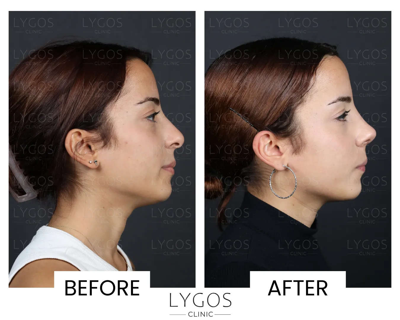 Slovakian nose rhinoplasty cost find affordable surgery options today