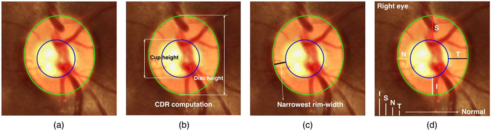 Eye Cup Disc Ratio Meaning Explained: How to Read Your Test Results